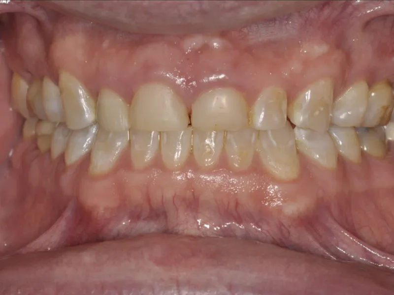 Case 0113 Retracted Before photo