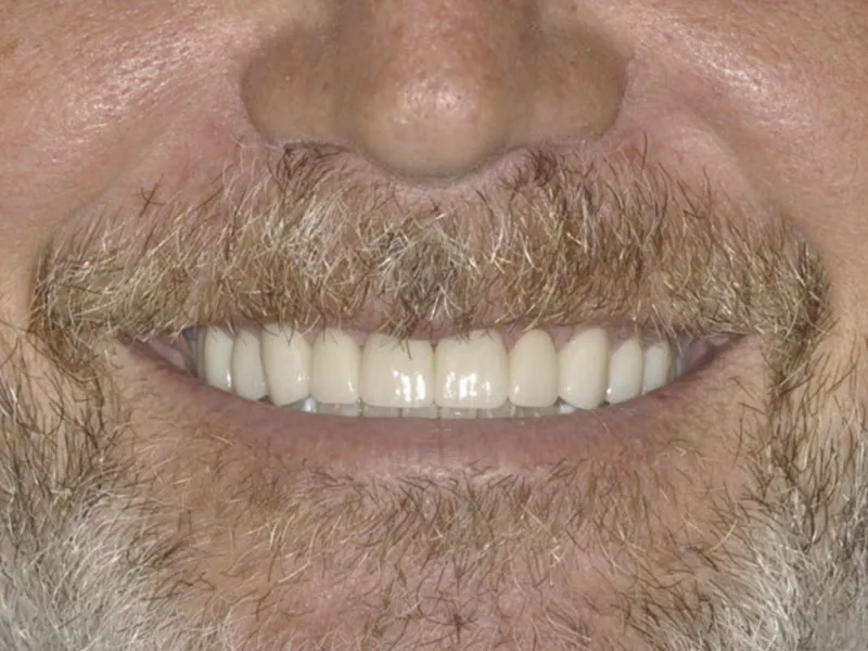 case 0113 smile after photo