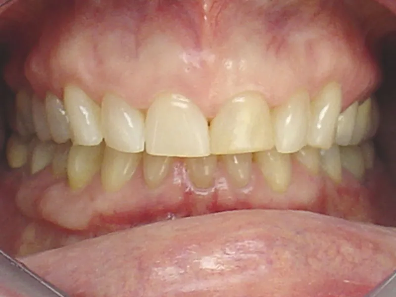 case 012 retracted before photo