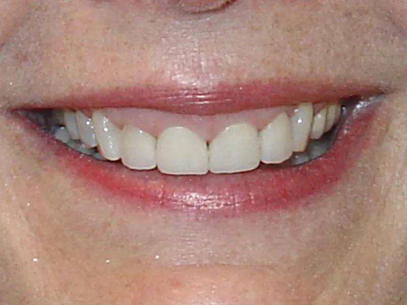case 012 smile after photo