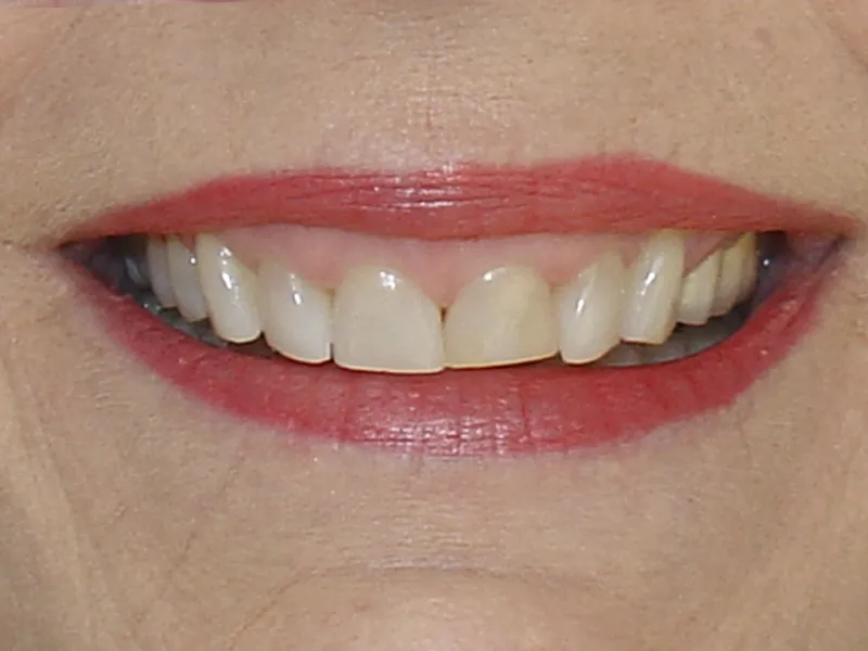 case 012 smile before photo