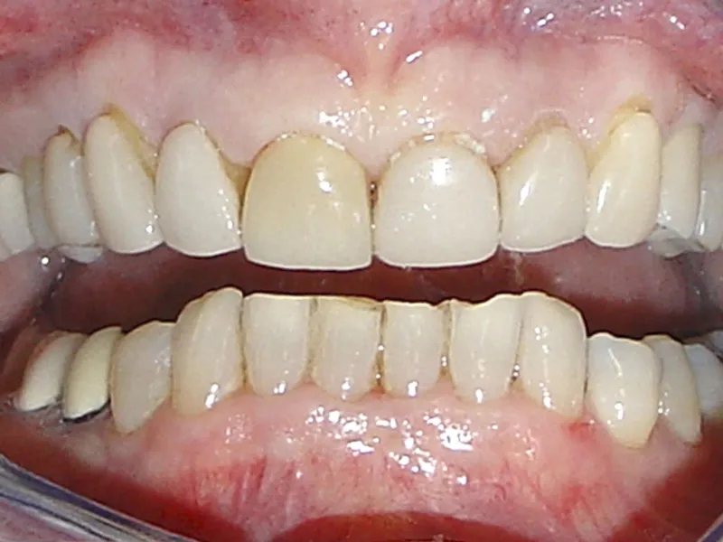 case 015 retracted before photo