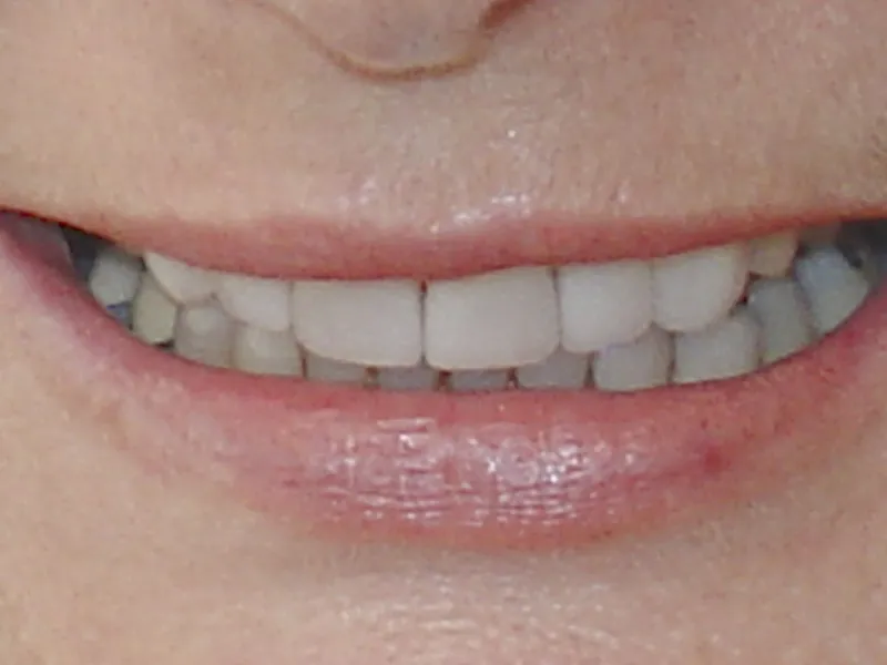 case 015 smile after photo