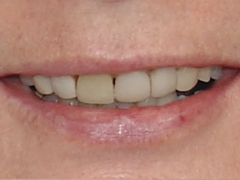 case 015 smile before photo