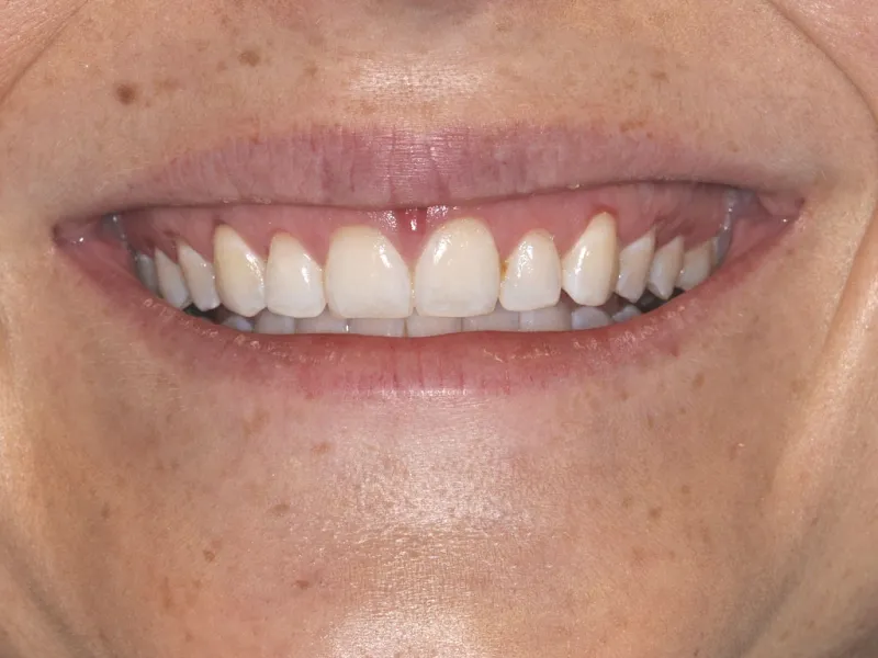 case 016 smile after photo