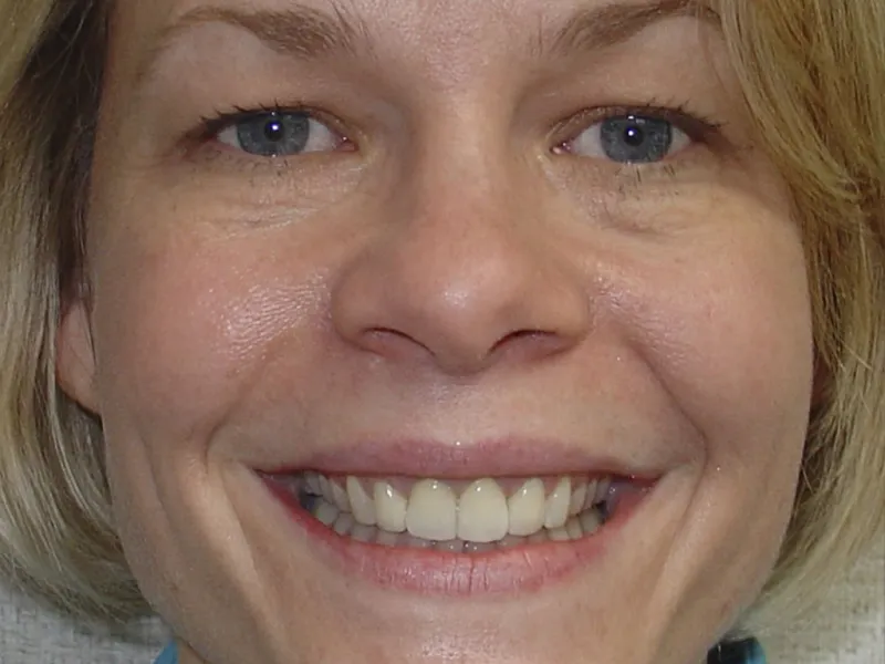 case 019 full face after photo