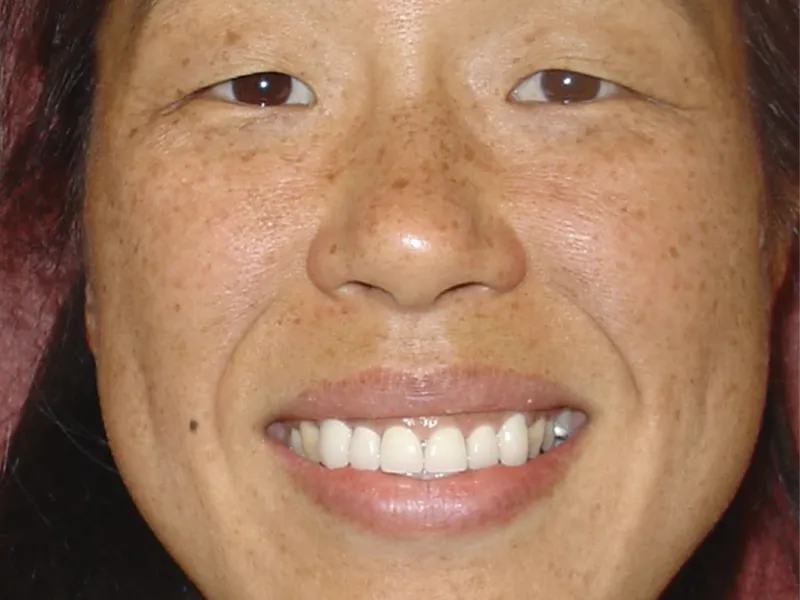 case 026 full face after photo
