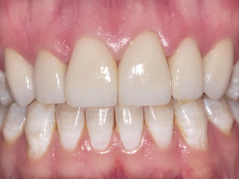 case 030 retracted after photo