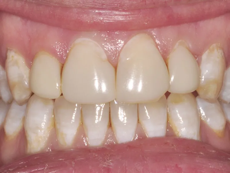 case 030 retracted before photo