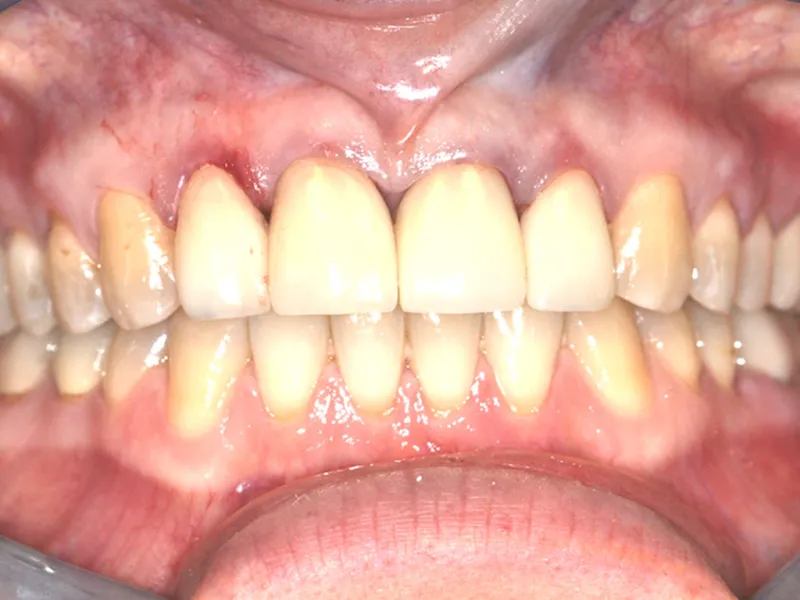 case 036 retracted before photo
