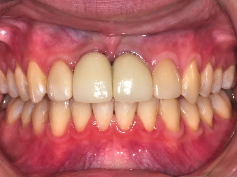 case 039 retracted after photo