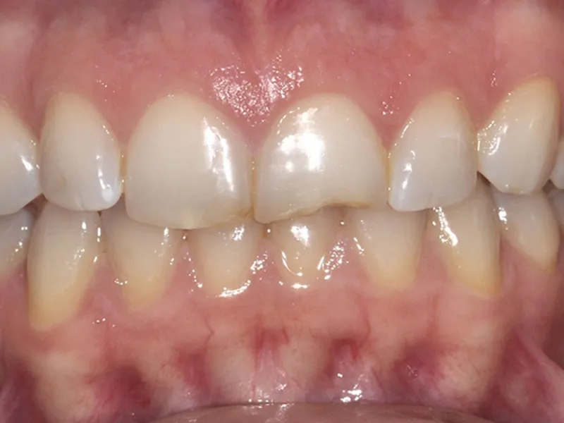 case 042 retracted before photo