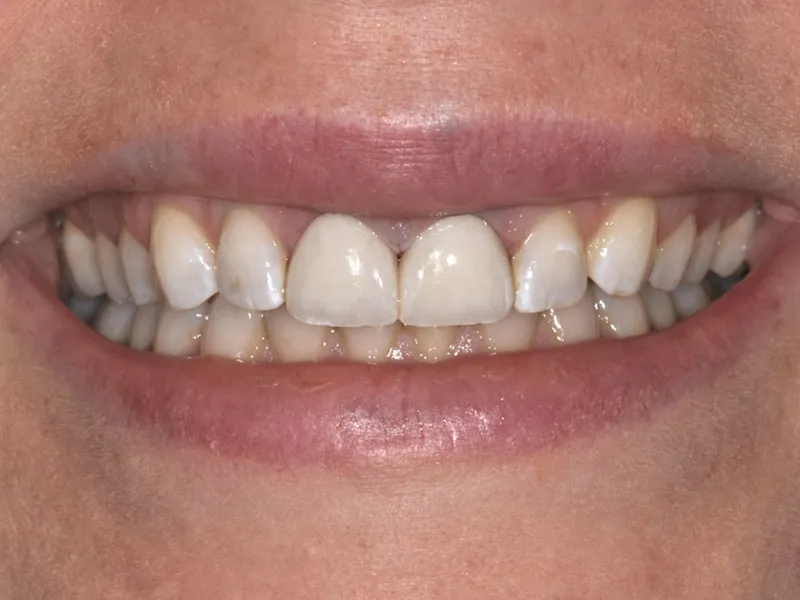 case 042 smile after photo
