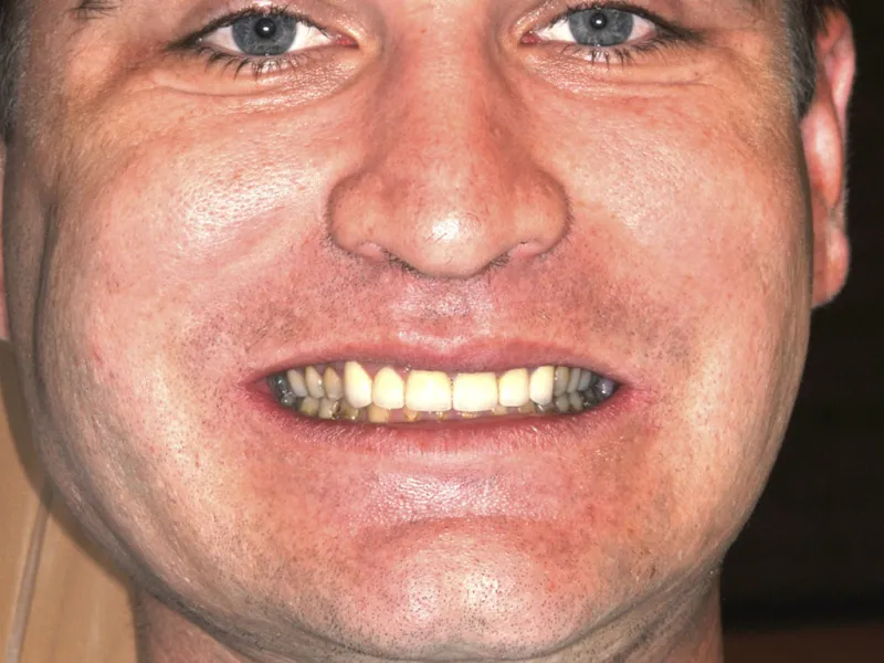 case 043 full face after photo