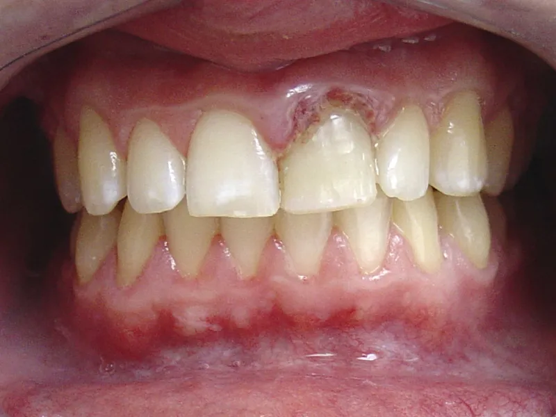 case 046 retracted before photo