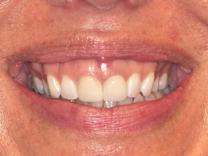 case 049 smile after photo
