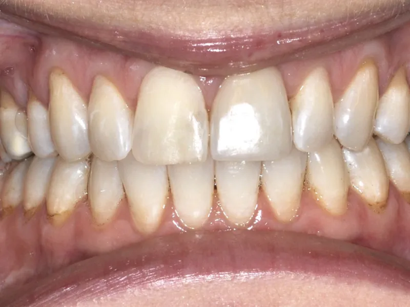 case 050 retracted after photo