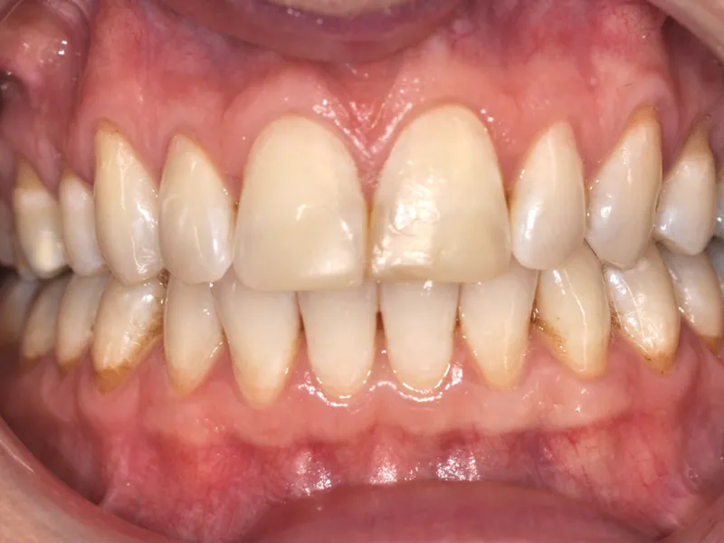 case 050 retracted before photo