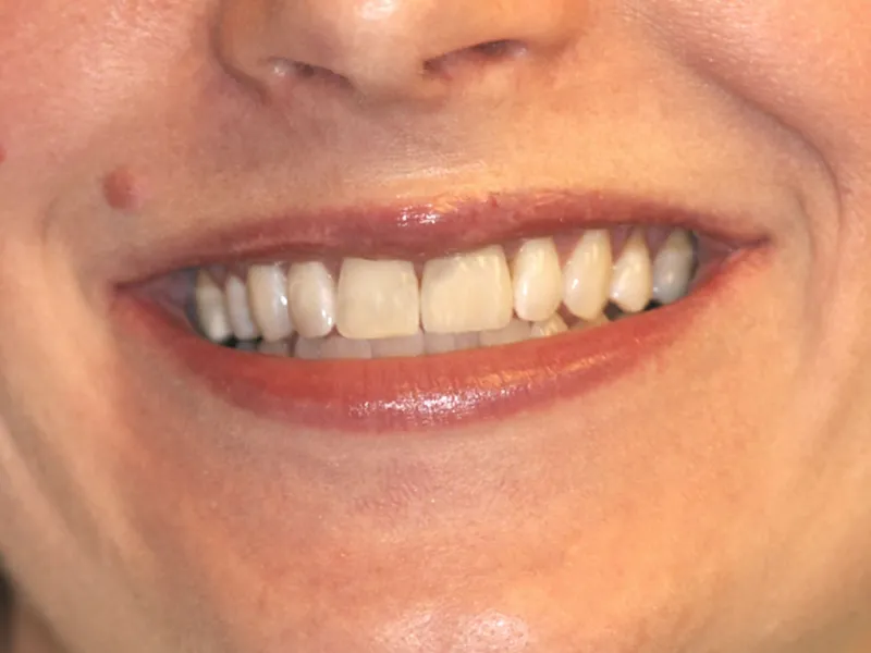 case 050 smile after photo