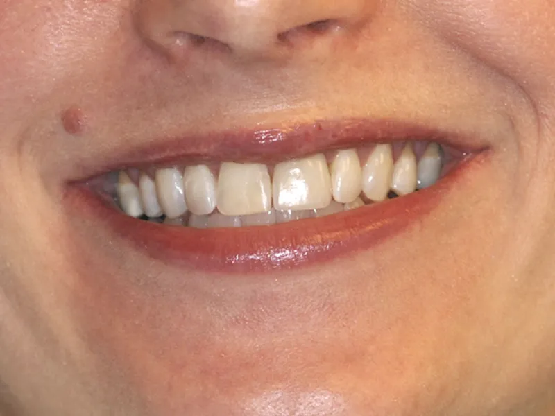 case 050 smile before photo