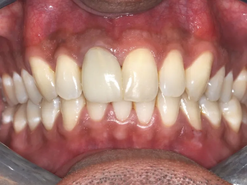 case 051 retracted after photo