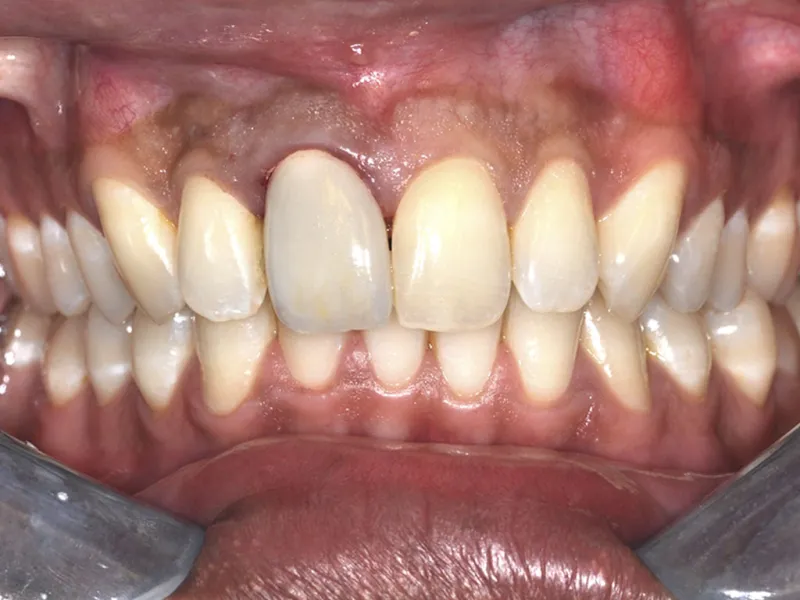 case 051 retracted before photo