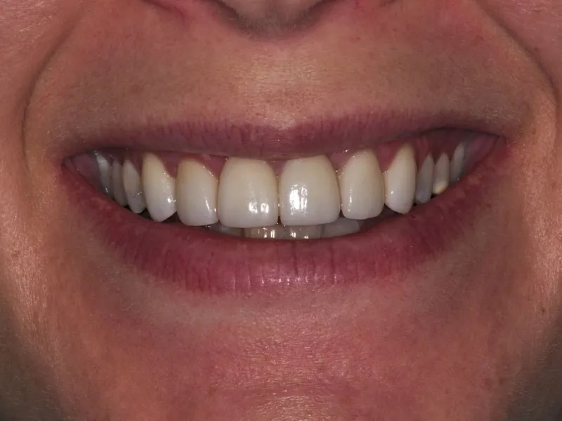 case 052 smile after photo