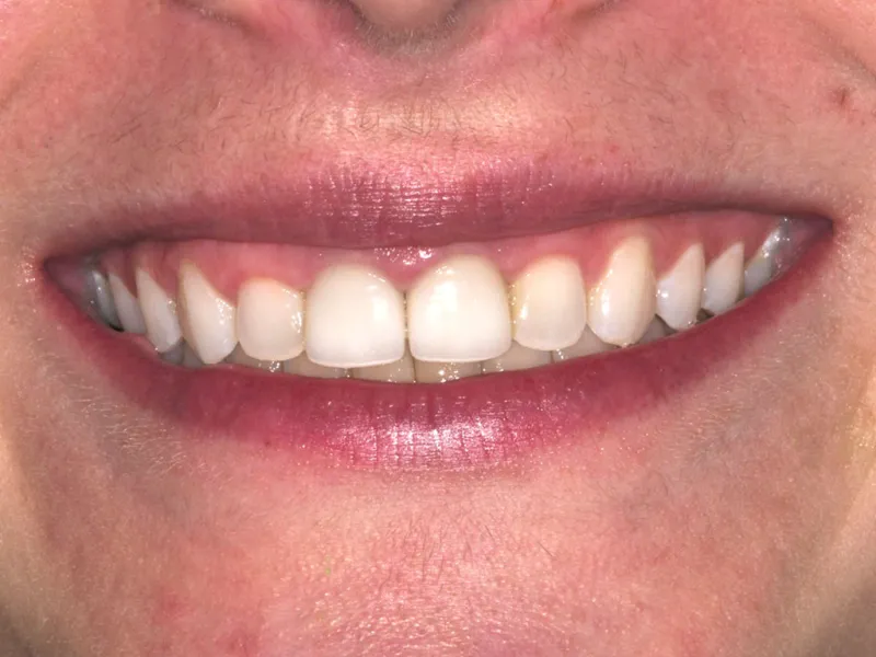 case 054 smile after photo