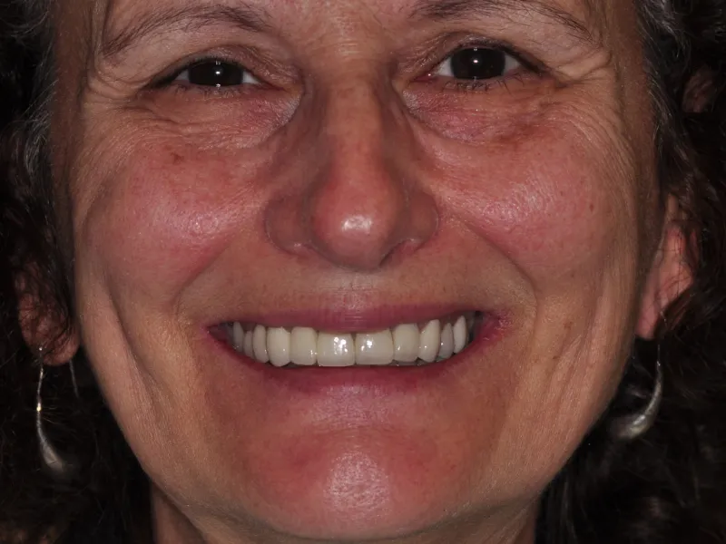 case 058 full face after photo