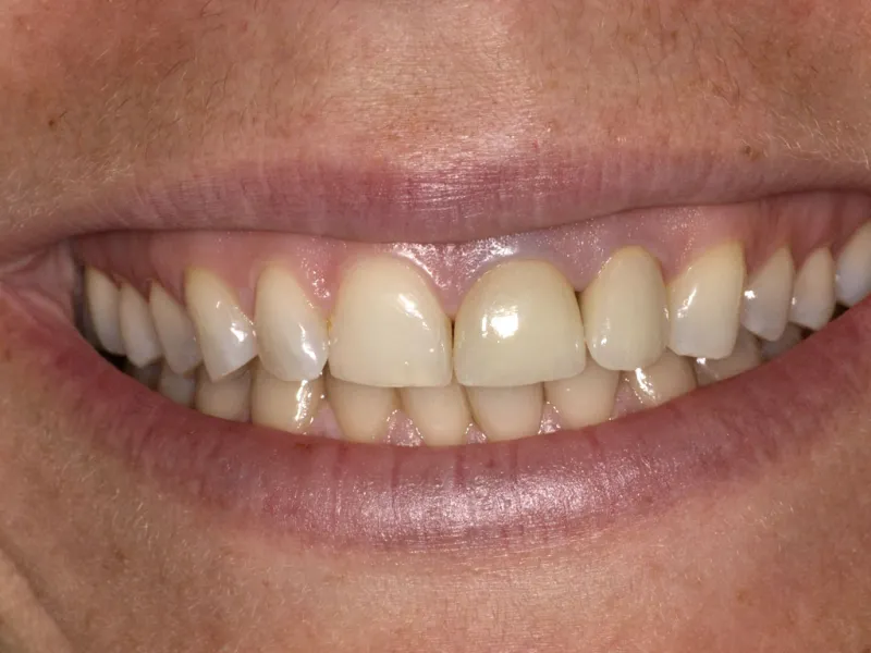 case 065 smile after photo