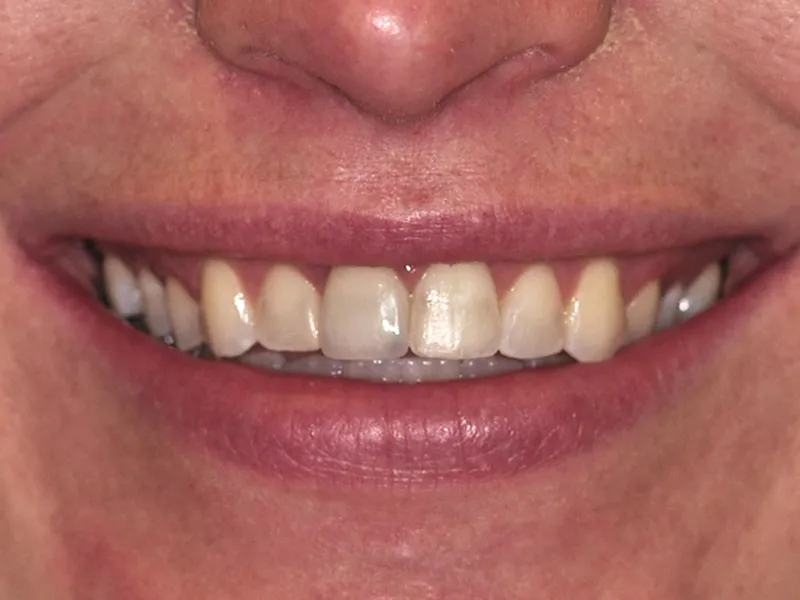 case 069 smile after photo