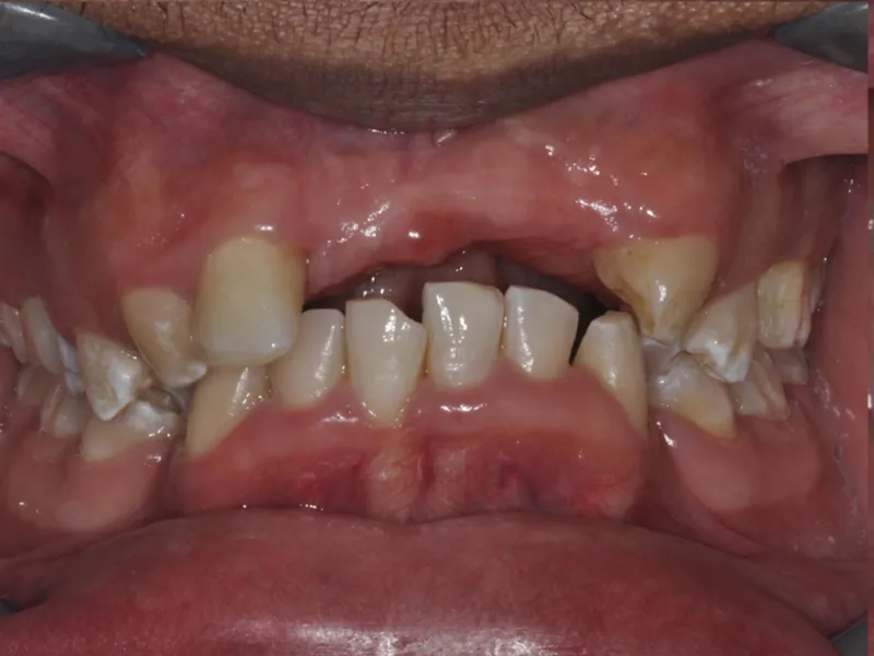 case 080 retracted before photo
