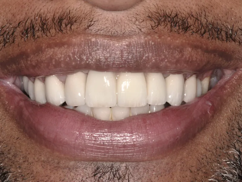 case 080 smile after photo