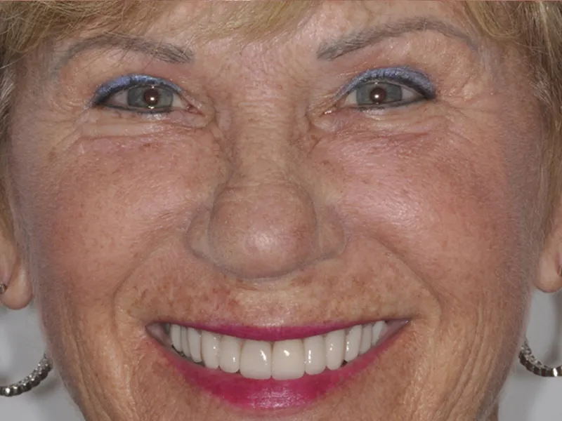 case 087 full face after photo