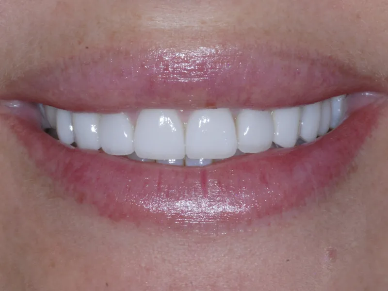 case 091 smile after photo