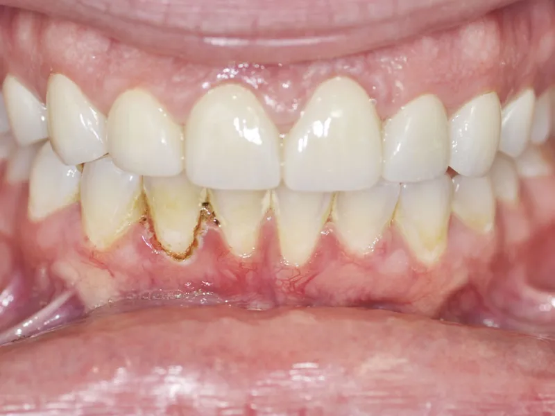 An after photo of case 300 retracted