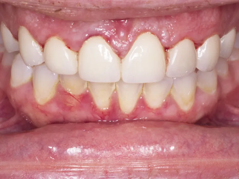 case 300 retracted before photo