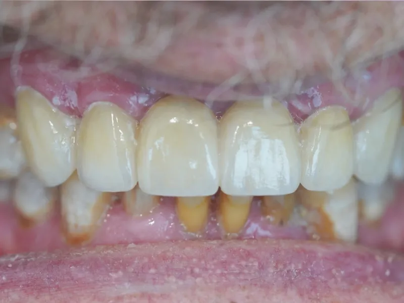 Case 301 Retracted After photo