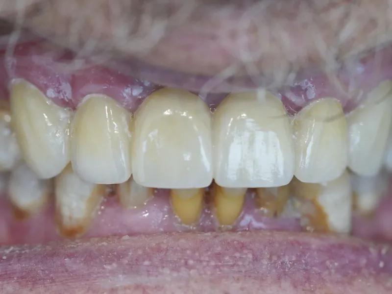 case 301 retracted after photo