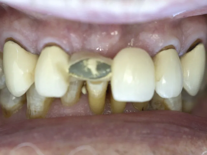 case 301 retracted before photo
