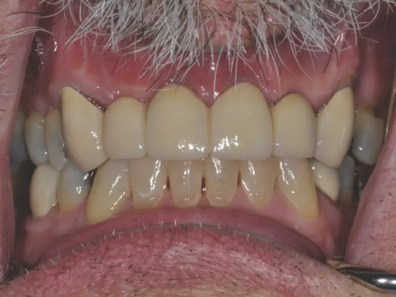 Case 302 Retracted After photo