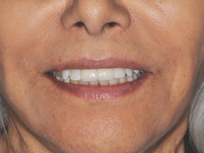Case 303 closeup after photo