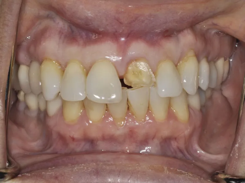 A photo of case 303 retracted before