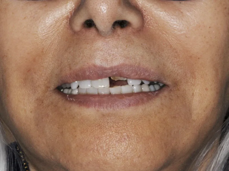 A photo of case-303 smile before
