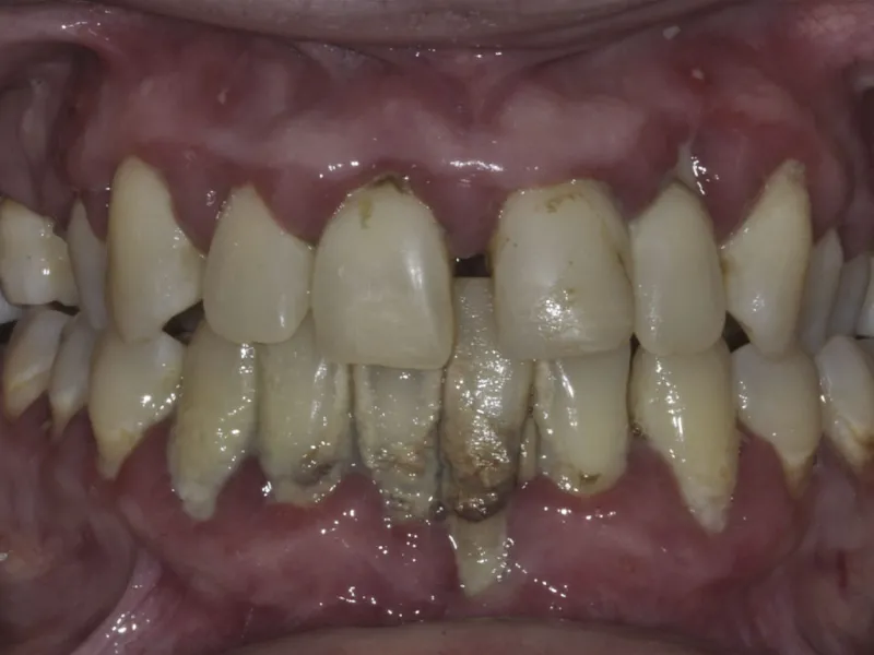 Case 310 Retracted Before photo