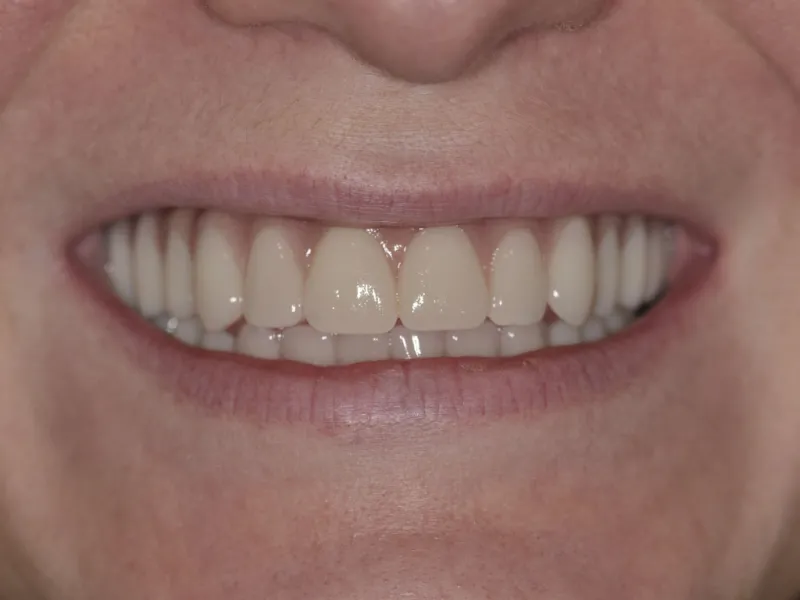 Case 310 Smile after photo