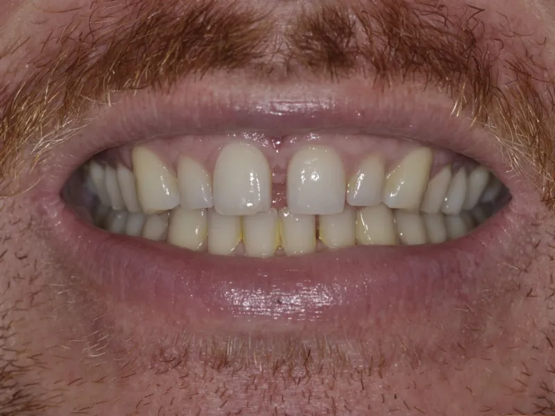 Photo case 312 smile before 