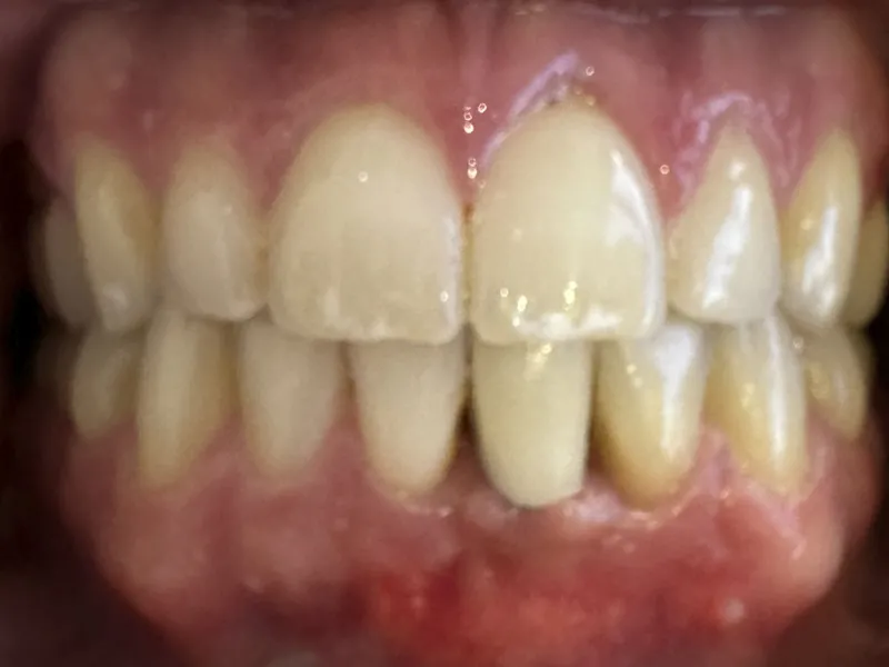 Case 501 Retracted After photo