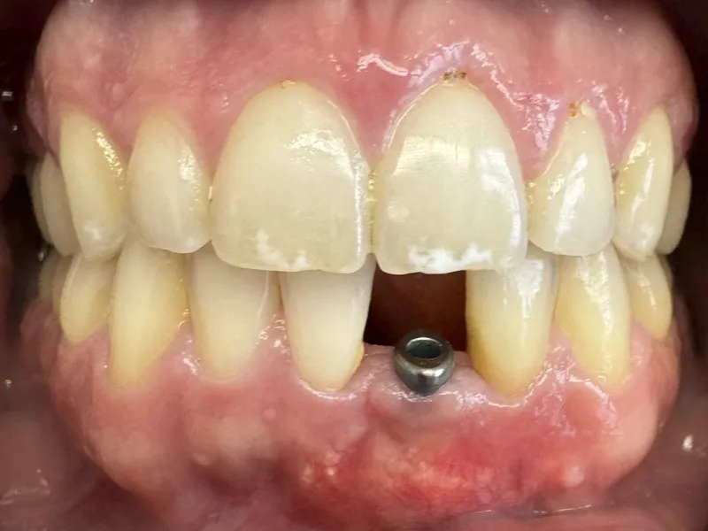Case 501 Retracted Before photo