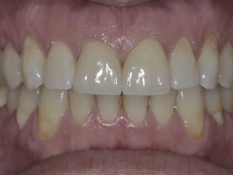 Case 505 Retracted After photo